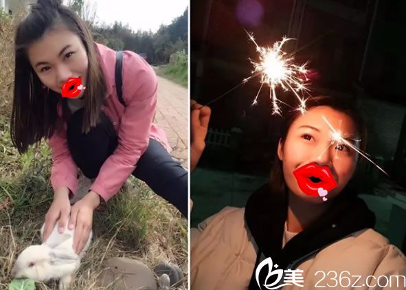 做鼻綜合隆鼻前的塌鼻子 做鼻綜合隆鼻前的塌鼻子