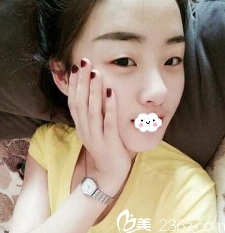 淮北微悅(伊爾美)醫(yī)療美容門診部雙眼皮術(shù)前 淮北微悅(伊爾美)醫(yī)療美容門診部雙眼皮術(shù)前