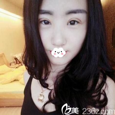 淮北微悅(伊爾美)醫(yī)療美容門診部胡斌雙眼皮案例 淮北微悅(伊爾美)醫(yī)療美容門診部胡斌雙眼皮案例