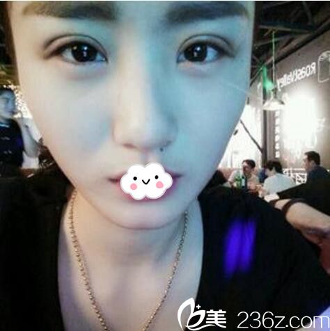 淮北微悅(伊爾美)醫(yī)療美容門診部全切雙眼皮案例 淮北微悅(伊爾美)醫(yī)療美容門診部全切雙眼皮案例