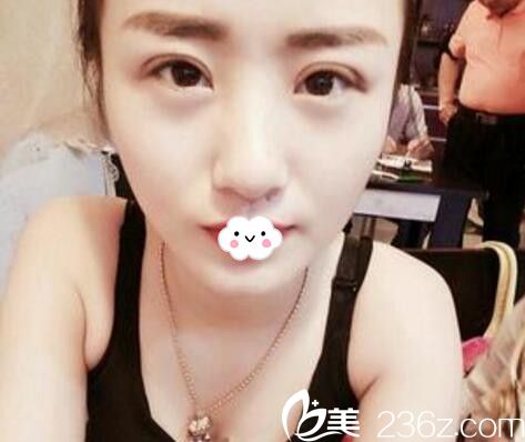 淮北微悅(伊爾美)醫(yī)療美容門診部整形美容醫(yī)院全切雙眼皮術(shù)后1月 淮北微悅(伊爾美)醫(yī)療美容門診部整形美容醫(yī)院全切雙眼皮術(shù)后1月