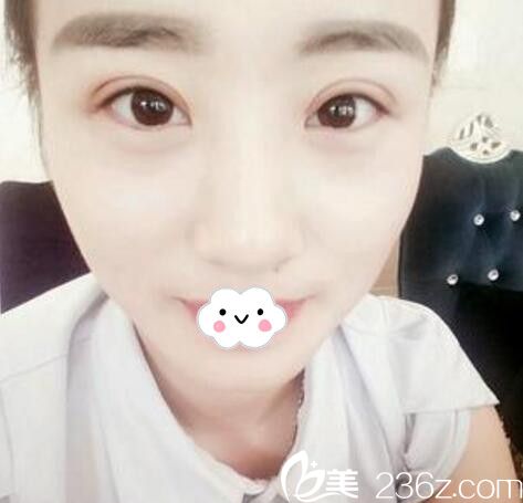 閨蜜說淮北微悅胡斌手術好 帶我來做全切雙眼皮真實體驗！