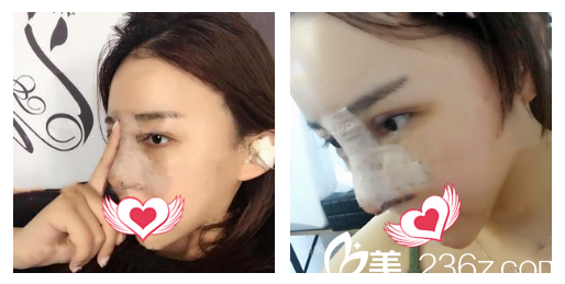 安徽蚌埠國(guó)色整形美容醫(yī)院做鼻綜合隆鼻術(shù)后即刻樣子