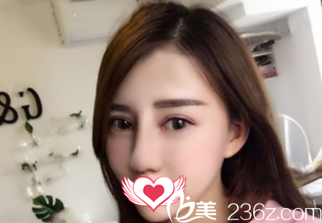 蚌埠國(guó)色整形美容醫(yī)院做鼻綜合隆鼻術(shù)后第9天拆線后恢復(fù)情況展示