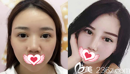去蚌埠國(guó)色整形美容醫(yī)院做鼻綜合隆鼻前后對(duì)比照
