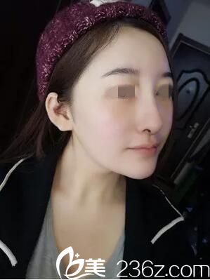 術(shù)后五天效果 術(shù)后五天效果