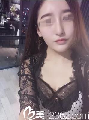 武漢新至美自體耳軟骨隆鼻效果圖片展示和案例分享