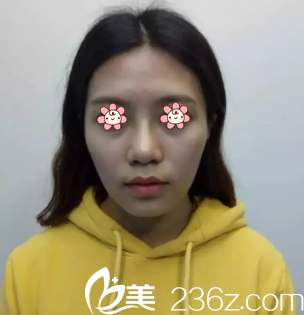 術(shù)前的我 術(shù)前的我