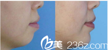 韓國LK整形外科醫(yī)院案例 韓國LK整形外科醫(yī)院案例