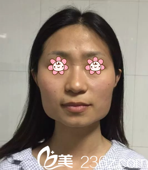 我術(shù)前樣子 我術(shù)前樣子