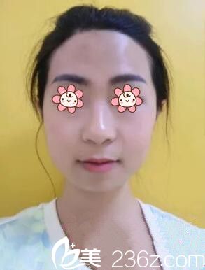 姬廣翰顴弓內(nèi)推+下頜角切除術(shù)后21天 姬廣翰顴弓內(nèi)推+下頜角切除術(shù)后21天