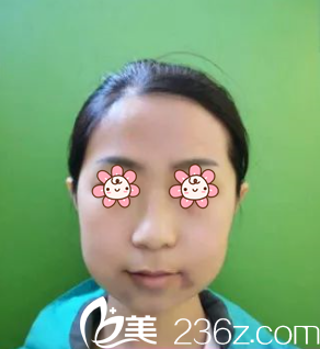 完全拆線了 完全拆線了