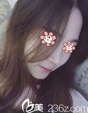 基本消腫了 基本消腫了