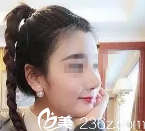 常德伊麗莎白盧開(kāi)銳院長(zhǎng)給我做的鼻失敗修復(fù)兩個(gè)月恢復(fù)過(guò)程