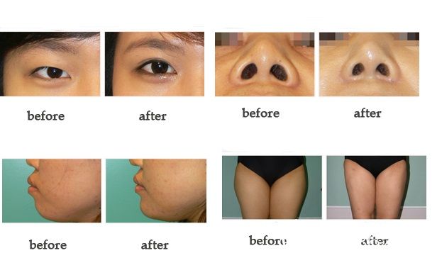 韓國(guó)知人整形外科整形案例 韓國(guó)知人整形外科整形案例