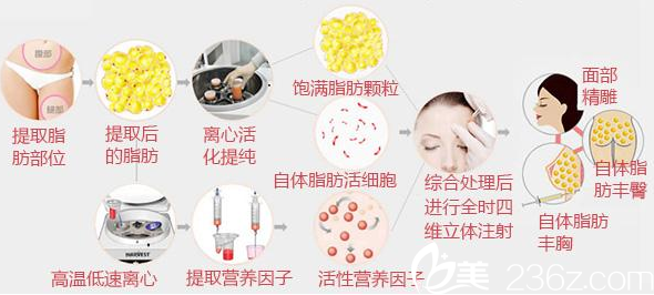 醫(yī)生講解自體脂肪活細(xì)胞移植過程 醫(yī)生講解自體脂肪活細(xì)胞移植過程