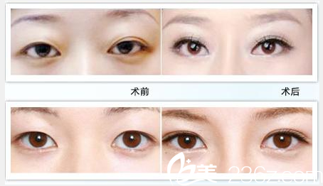 悅美整形美容醫(yī)院雙眼皮案例