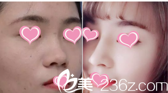 術(shù)前術(shù)后對比圖 術(shù)前術(shù)后對比圖