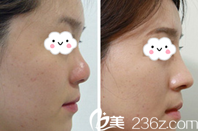 東營藝美李琳隆鼻案例前后對比 東營藝美李琳隆鼻案例前后對比