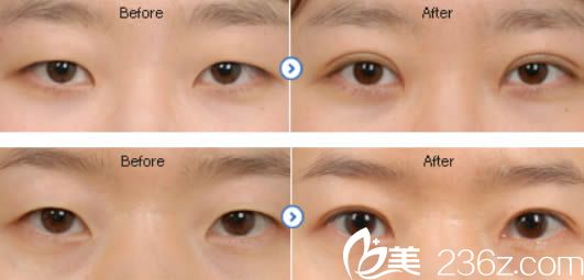 福州亞美之星整形醫(yī)院俞富興雙眼皮案例