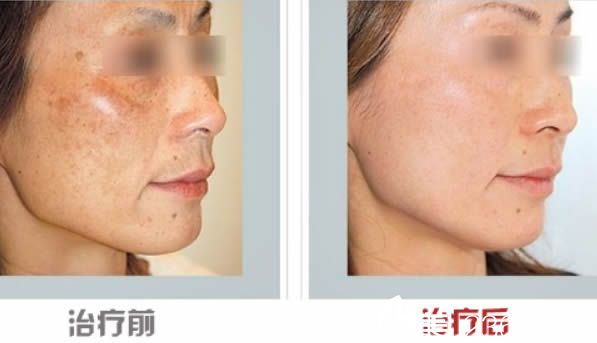 福州瑪恩皮膚美容門診劉劍激光祛黃褐斑前后對(duì)比效果圖 福州瑪恩皮膚美容門診劉劍激光祛黃褐斑前后對(duì)比效果圖