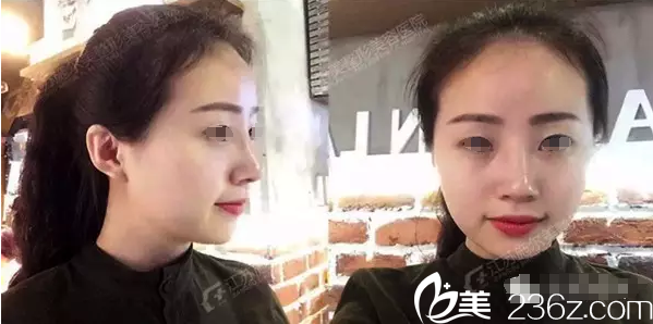 拆線術(shù)后恢復(fù)中