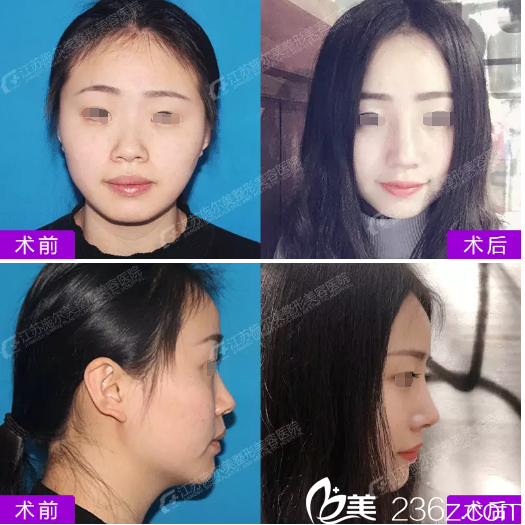 在江蘇施爾美做鼻綜合術(shù)前術(shù)后對(duì)比