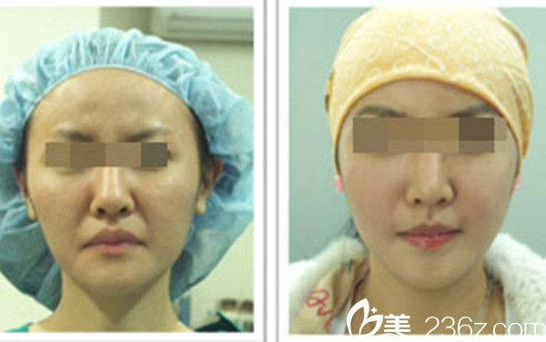 韓國美人制造整形醫(yī)院顴骨手術案例