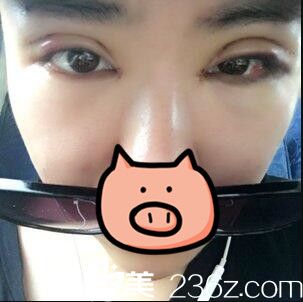 開內(nèi)眼角+全切雙眼皮真人案例術(shù)后天