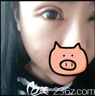 開內(nèi)眼角+全切雙眼皮真人案例術(shù)后第七天