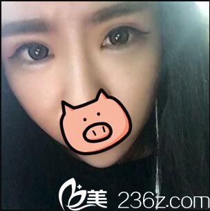 開內(nèi)眼角+全切雙眼皮真人案例術(shù)后二十天天