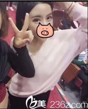 開內(nèi)眼角+全切雙眼皮真人案例術(shù)后三十三天