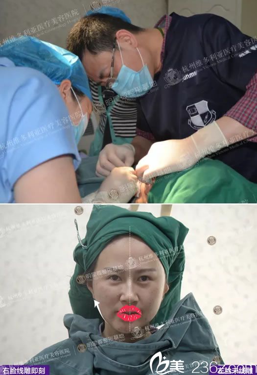 程健院長做線雕手術過程