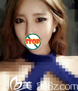 顴骨整形術(shù)后2個(gè)月<span style=