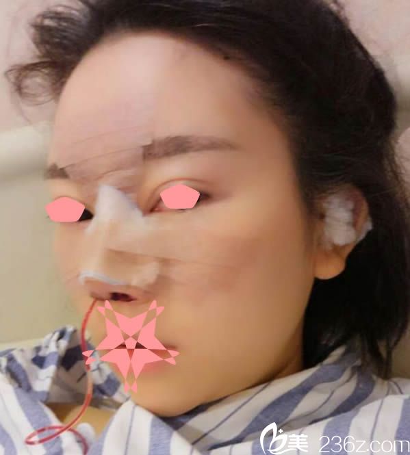 做完鼻綜合手術(shù)第1天的樣子