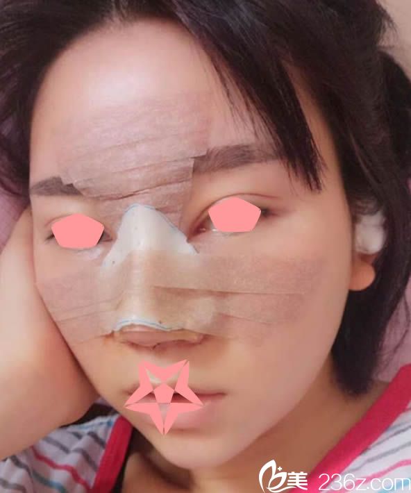 鼻翼內(nèi)切和耳軟骨墊鼻尖術(shù)后第2天