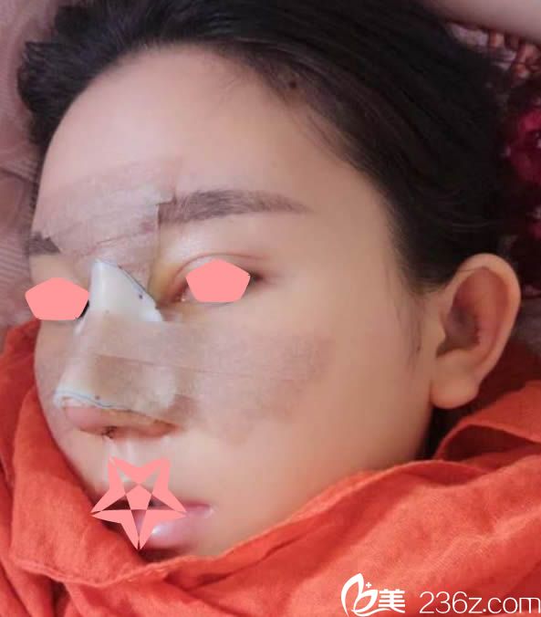 綜合隆鼻術(shù)后第4天