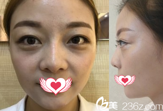 沒有去亳州締美做全臉自體脂肪填充前的樣子 沒有去亳州締美做全臉自體脂肪填充前的樣子