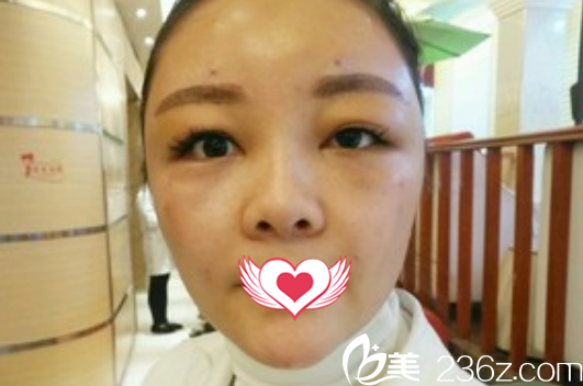 在亳州締美整形做自體脂肪能填充面部術(shù)后第1天恢復(fù)情況 在亳州締美整形做自體脂肪能填充面部術(shù)后第1天恢復(fù)情況