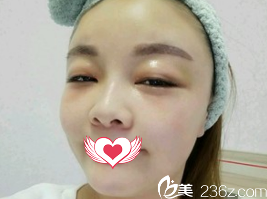 找亳州締美邢志平做自體脂肪填充面部術(shù)后第6天恢復(fù)效果展示 找亳州締美邢志平做自體脂肪填充面部術(shù)后第6天恢復(fù)效果展示