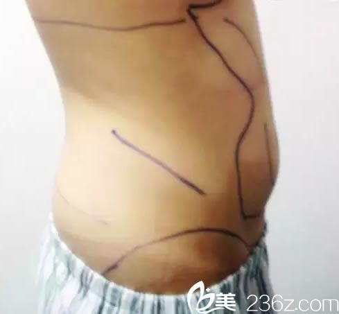 金華亞美趙延嶺設(shè)計(jì)吸脂方案