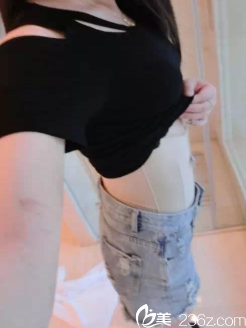 金華亞美腰腹吸脂<span style=