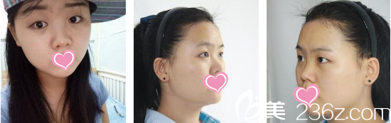 西安葉子醫(yī)院雙眼皮真實<span style= 西安葉子醫(yī)院雙眼皮真實<span style=