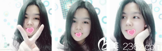 術(shù)后20天的樣子 術(shù)后20天的樣子