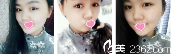 西安葉子整形醫(yī)院朱健康做雙眼皮+開(kāi)眼角效果真的挺不錯(cuò)的