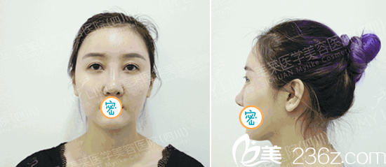 面部提升+線(xiàn)雕隆鼻術(shù)前照 面部提升+線(xiàn)雕隆鼻術(shù)前照