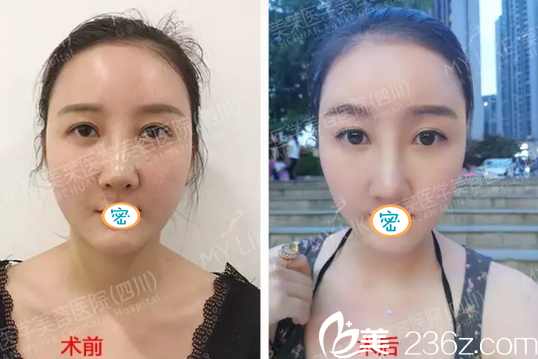 面部埋線(xiàn)提升+埋線(xiàn)隆鼻手術(shù)前后對(duì)比 面部埋線(xiàn)提升+埋線(xiàn)隆鼻手術(shù)前后對(duì)比