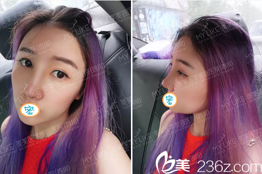 成都美萊謝仕喬面部線(xiàn)雕提升術(shù)后效果 成都美萊謝仕喬面部線(xiàn)雕提升術(shù)后效果