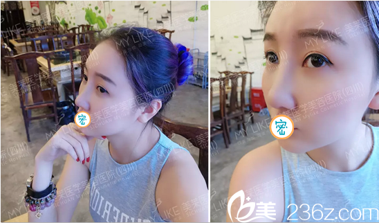 成都美萊謝仕喬面面部埋線提升+線雕隆鼻術(shù)后15天 大家給我的變化打幾分？