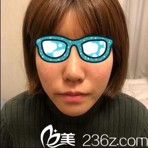 韓國清潭整形外科李丙玟鼻綜合真人案例 韓國清潭整形外科李丙玟鼻綜合真人案例